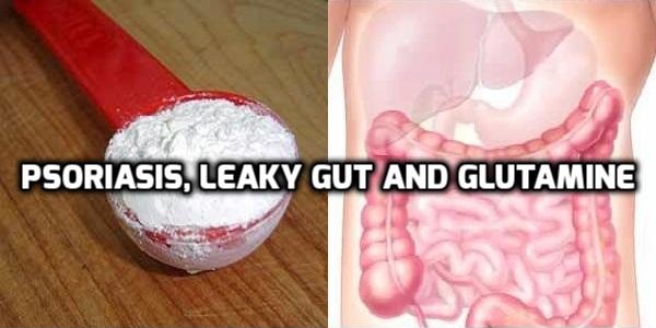 Glutamine helps repair leaky gut to heal psoriasis