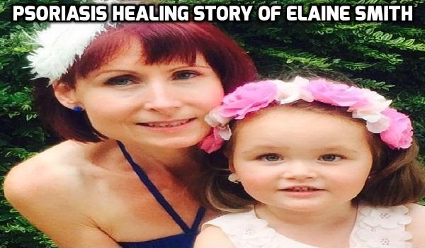 Psoriasis healing story of Elaine Smith