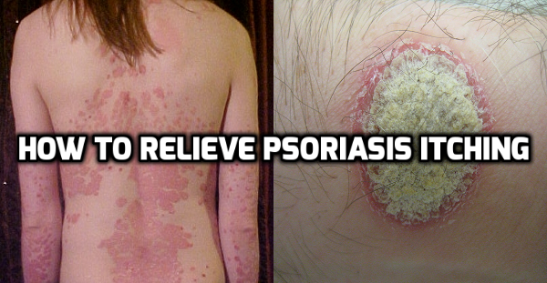 How to relieve Psoriasis itching