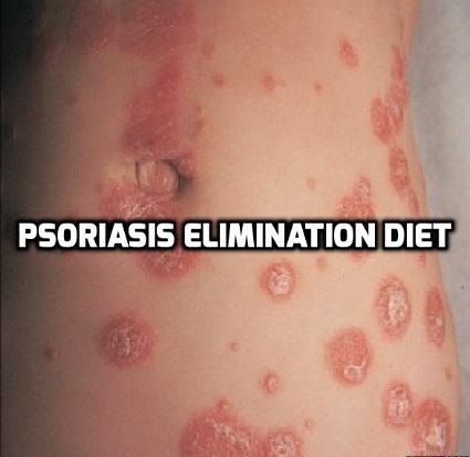 Psoriasis elimination diet