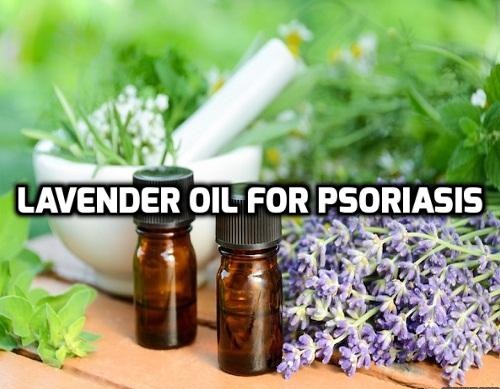 Lavender oil for Psoriasis