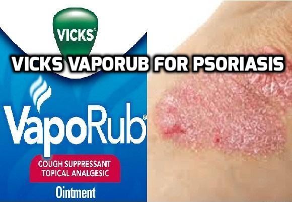 Vicks VapoRub for Psoriasis