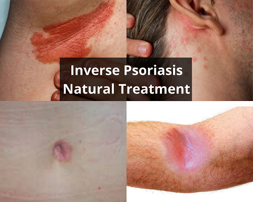 Inverse Psoriasis Natural Treatment
