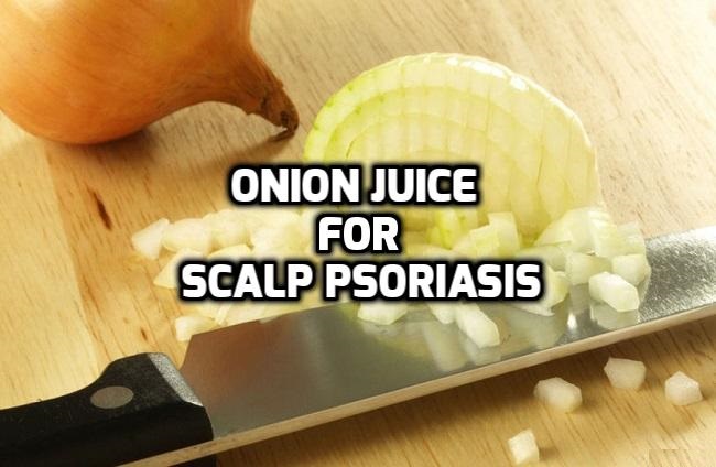 Onion Juice for Scalp Psoriasis